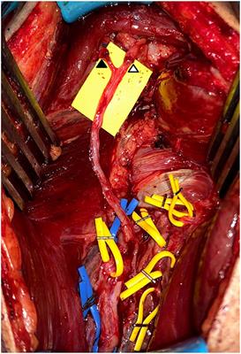 Defining the Reliability of <mark class="highlighted">Deltoid</mark> Reanimation by Nerve Transfer When Using Abnormal but Variably Recovered Triceps Donor Nerves